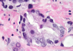 Prostate cancer viewed through a microscope.